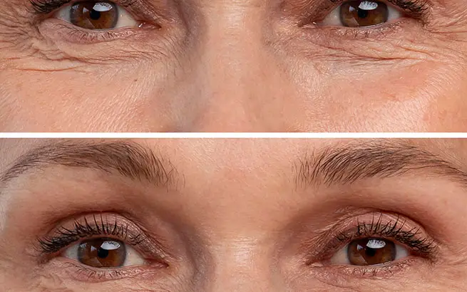 Benefits of Using Botox Treatment for Under Eye Wrinkles