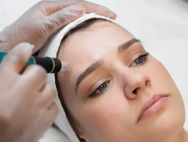 tempsure rf for forehead lines