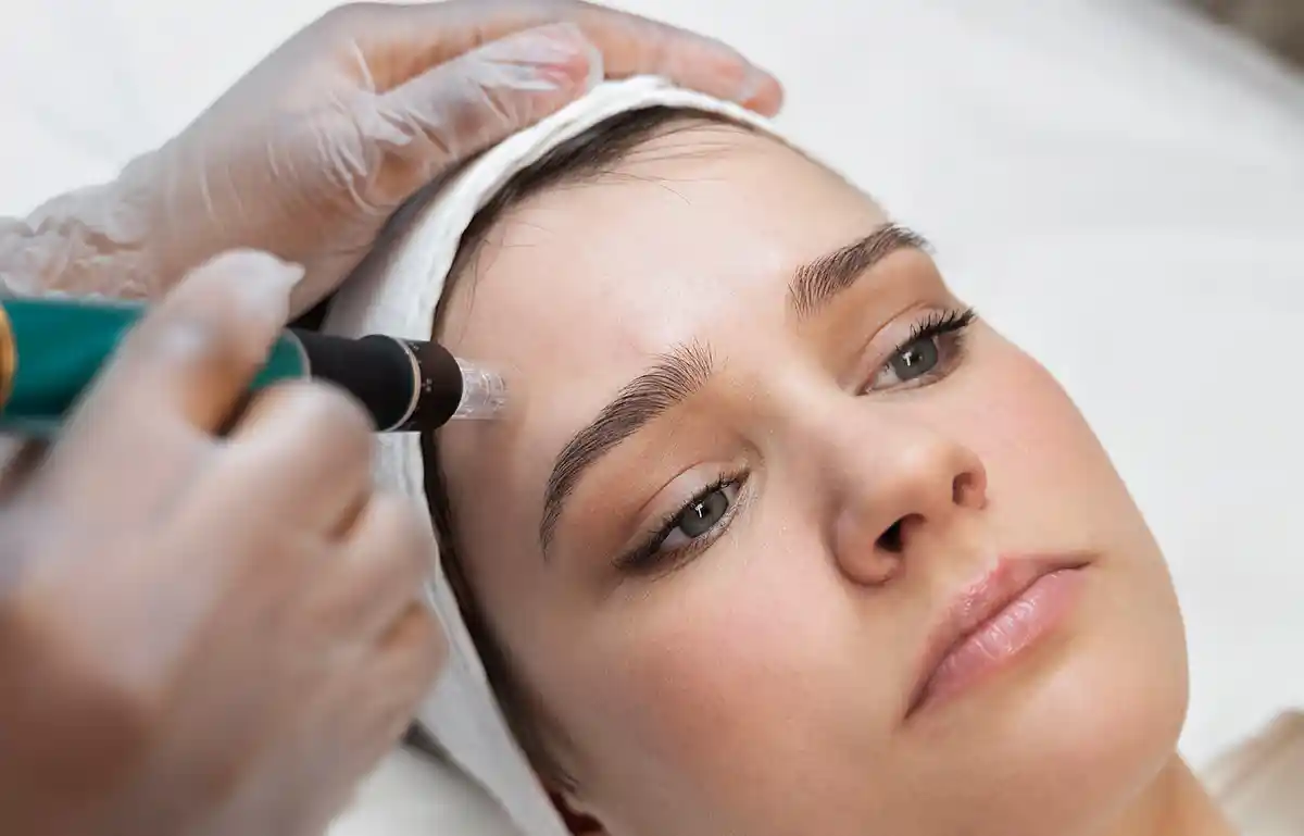 tempsure rf for forehead lines
