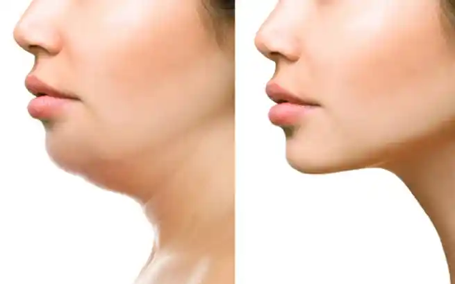 Before and After Jawline Treatment