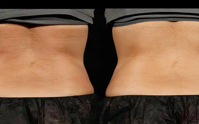 Major Benefits of Sculpsure for Love Handles