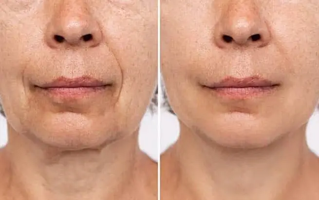 How Botox Eliminates Marionette Lines?