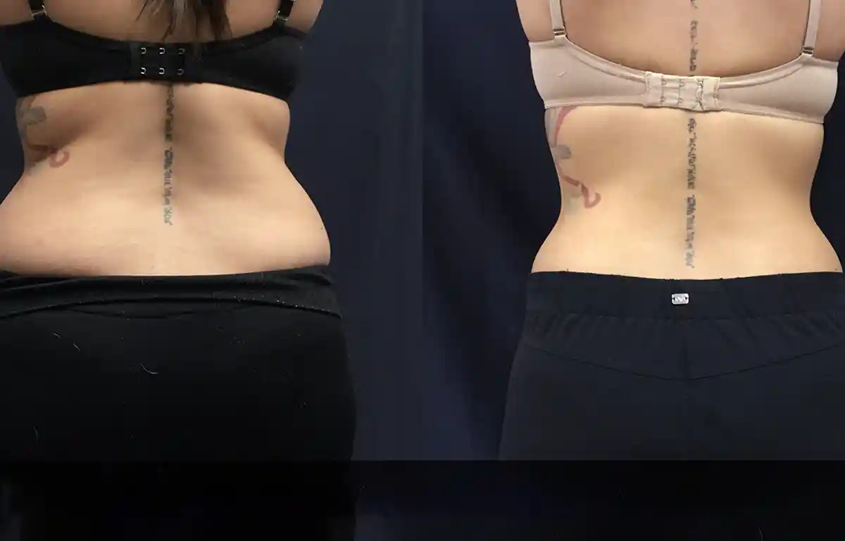 sculpsure love handles