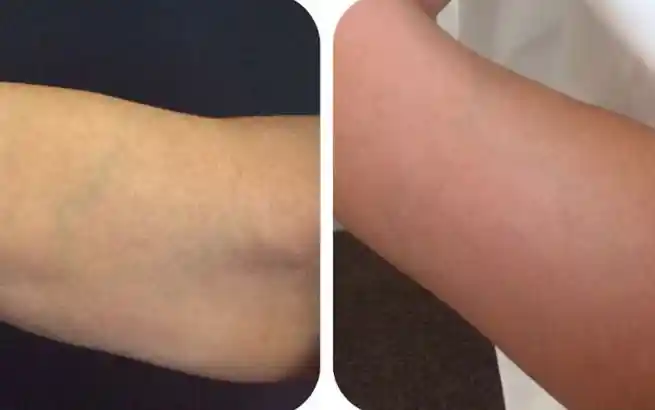 Steps Before and After the Sculpsure Treatment