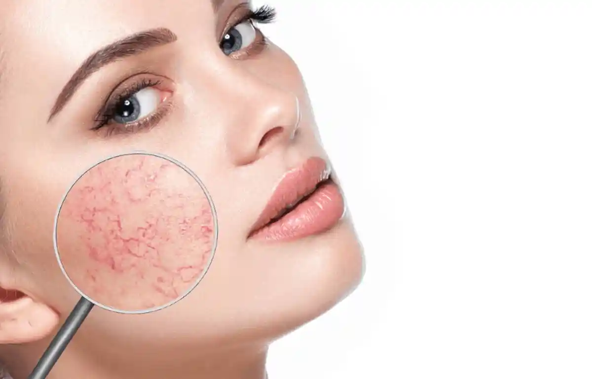 Laser vein removal face near me