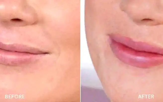 Advantages of Using Restylane Lip Fillers