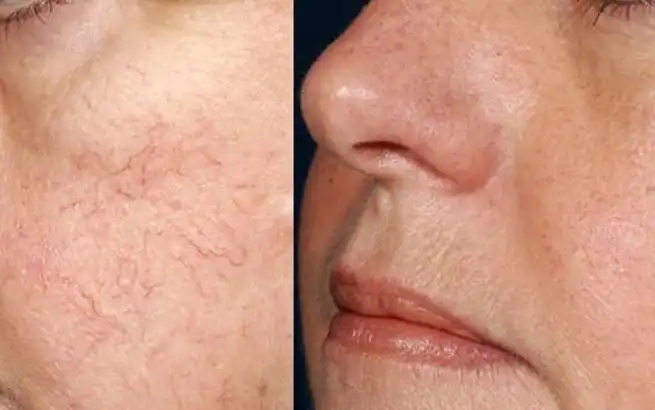 Benefits of using Laser Spider vein treatment