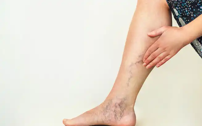 What Are Spider Veins