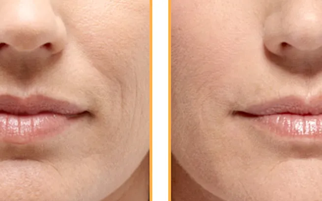 Benefits of Using Restylane for Smile Lines