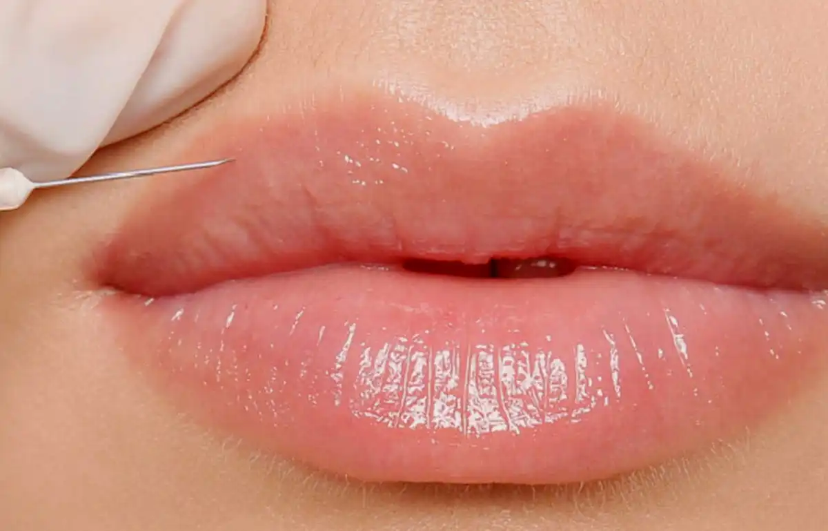 Restylane contour lips